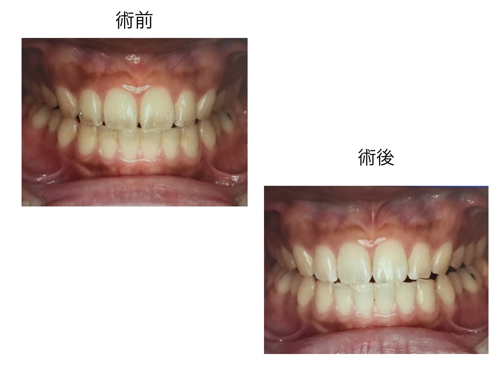 村上の歯